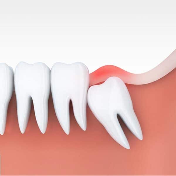 Affordable Wisdom Teeth Extraction In Temecula – Wisdom Teeth Extraction