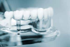 temecula dental implants