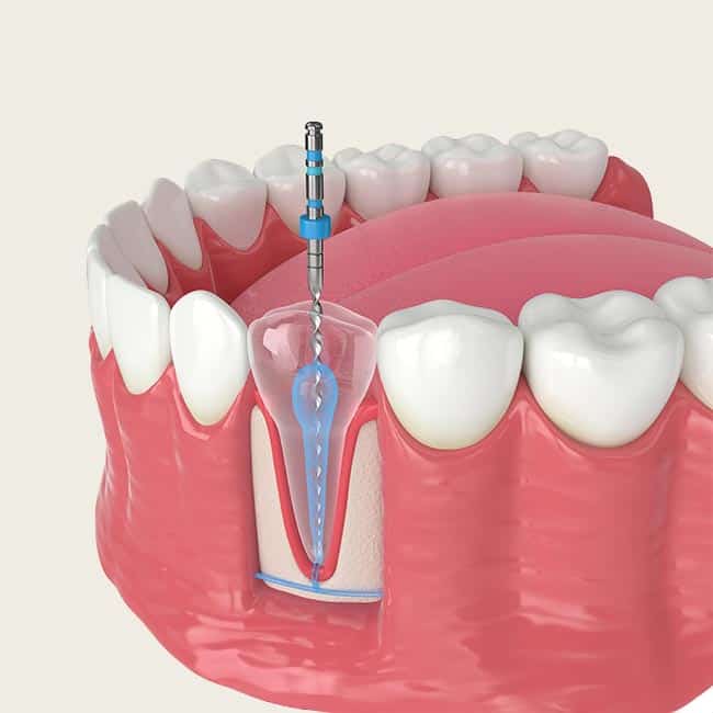 Root Canal Therapy