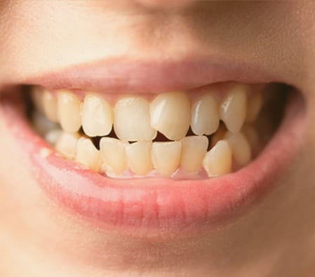 Crowded teeth corrected with Invisalign in Temecula
