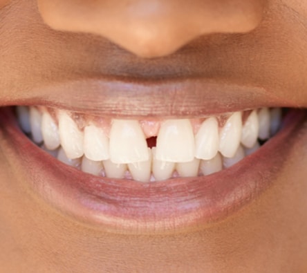 Gapped teeth treatable with Invisalign clear aligners