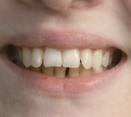 Overbite and bite correction with Invisalign