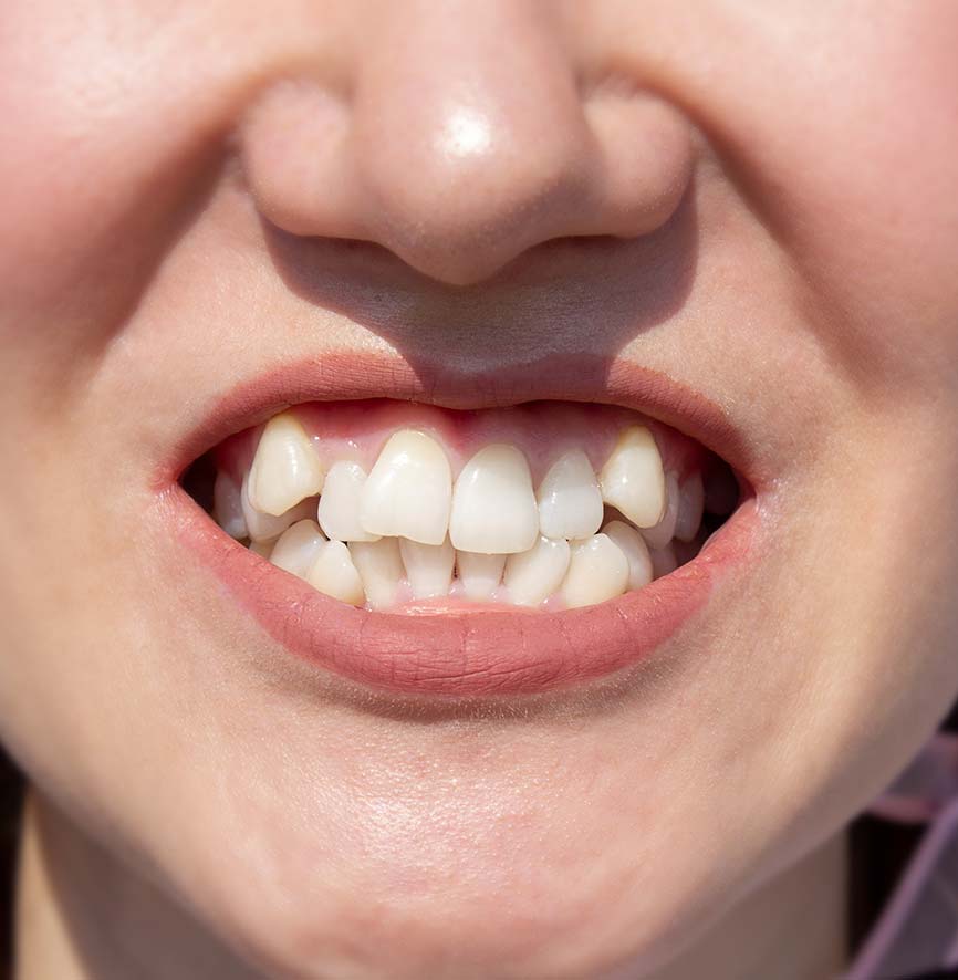 Crooked teeth assessed with an iTero digital scan in Temecula
