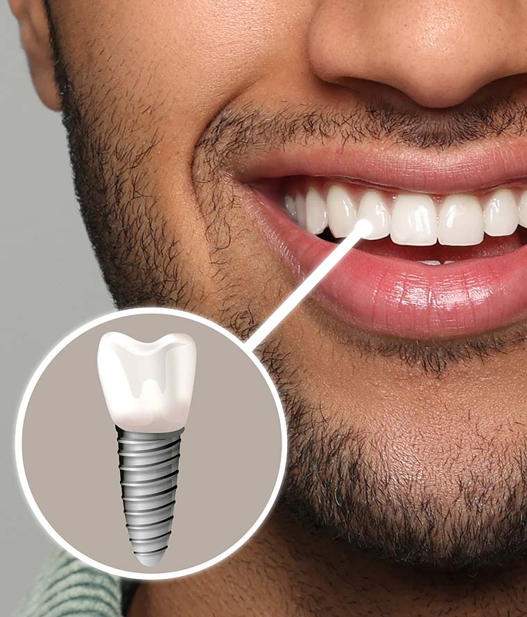 Dental implant model used to explain implant dentures in Temecula