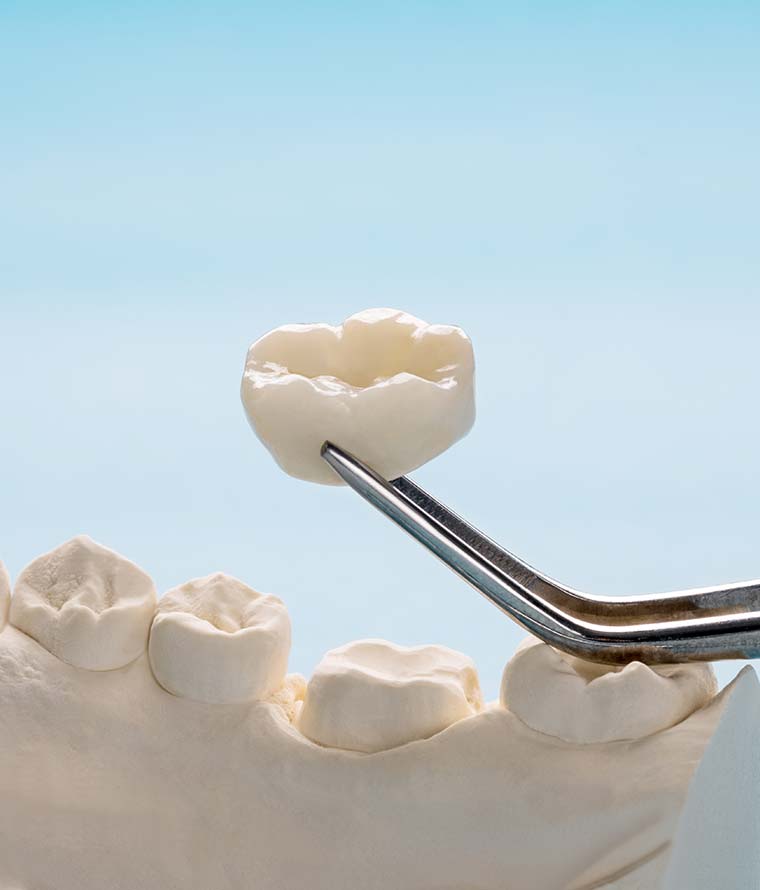 Porcelain dental crown being matched to a patient's teeth in Temecula